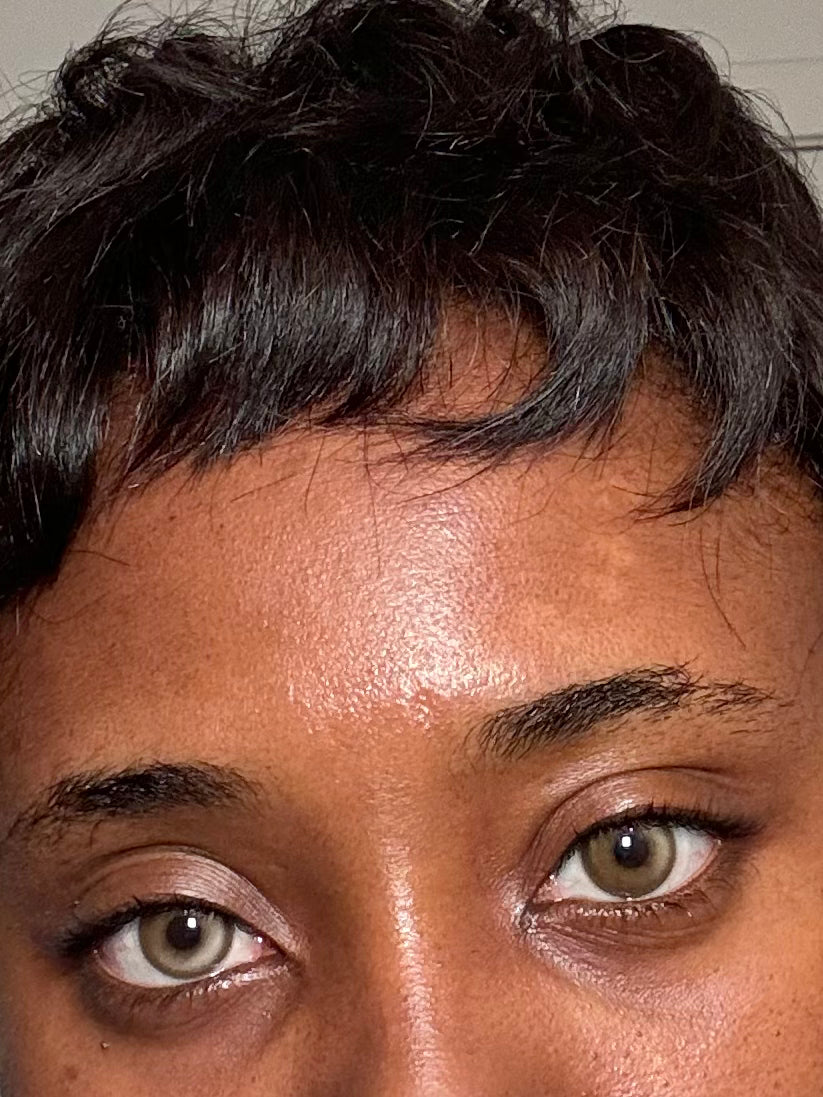 LVH contact lenses