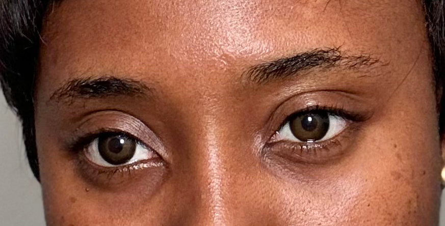 LVH contact lenses