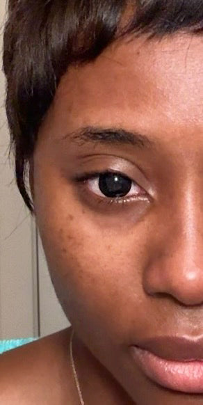LVH contact lenses