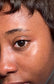 LVH contact lenses